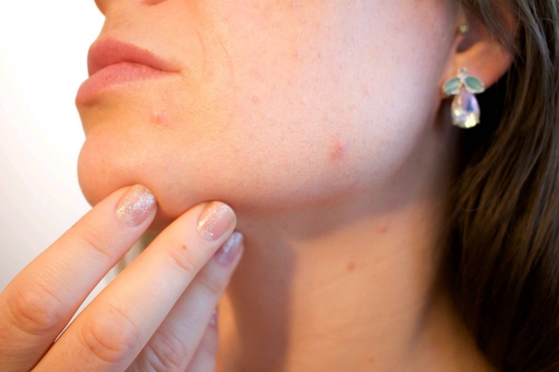 traiter l'acné sans médicament de manière naturelle